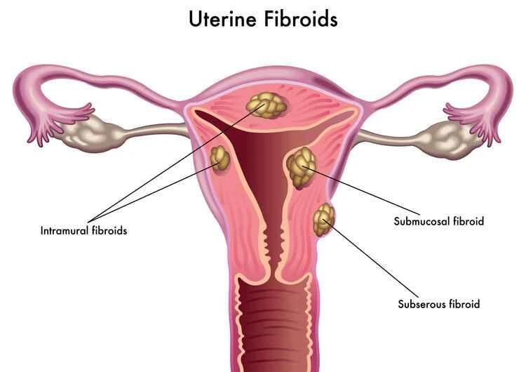 "If you have uterine fibroids, you can't have children": This rumor became his excuse for breaking off the engagement.